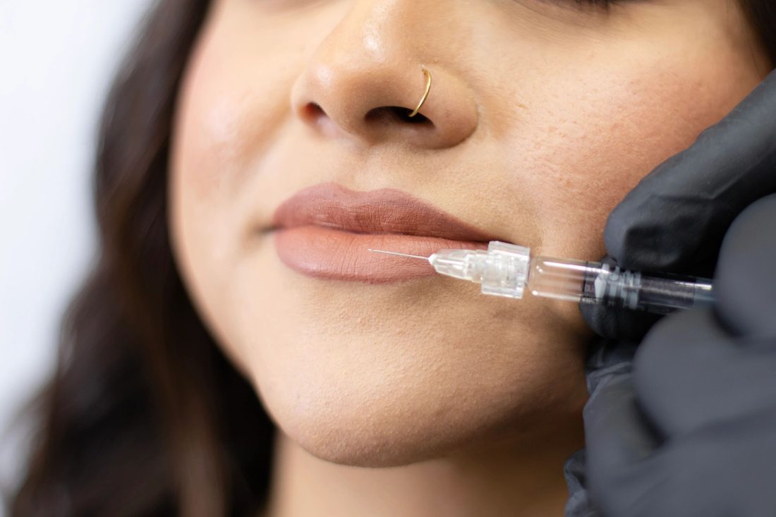 Lip filler treatment at Progress MD