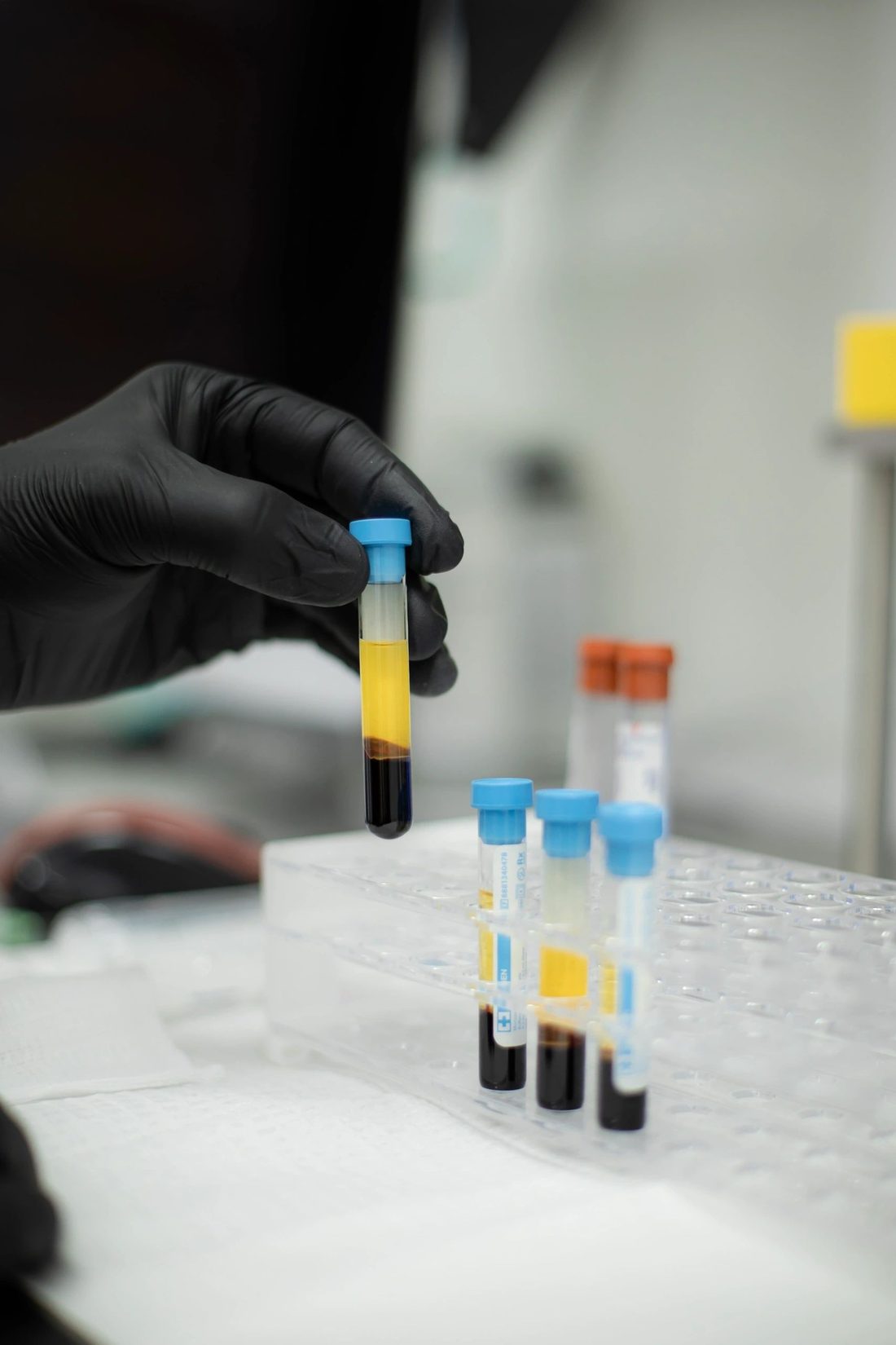 Platelet-rich plasma preparation at Progress MD