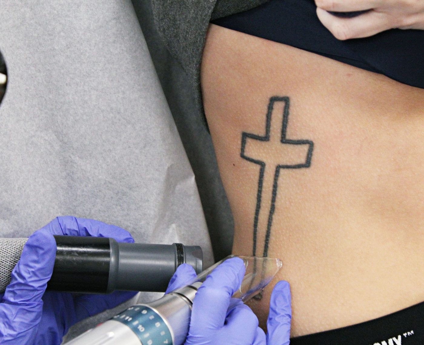 Laser treatment at Progress MD